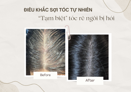 Tóc rẽ ngôi bị hói – Giải pháp che phủ tự nhiên