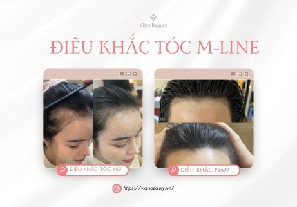 Khắc phục trán cao, hói M-Line bằng điêu khắc sợi tóc