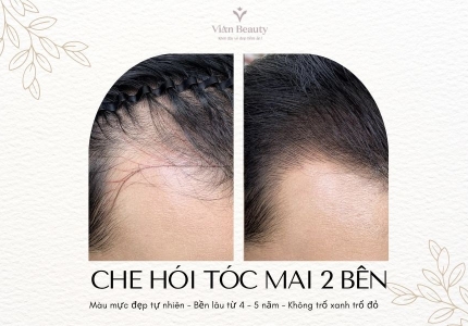 Che hói hai bên tóc mai bằng công nghệ điêu khắc sợi tóc