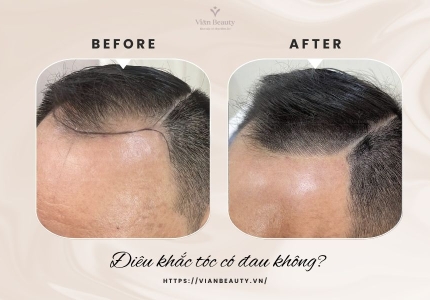 Điêu khắc tóc có đau và bong tróc không?