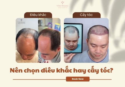 Nên chọn điêu khắc hay cấy tóc?