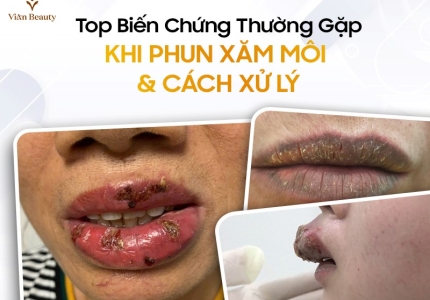 Top 8 Biến Chứng Thường Gặp Khi Phun Xăm Môi & Cách Xử Lý