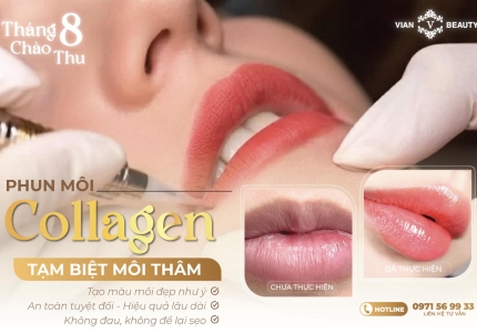 Phun môi collagen – Môi căng mịn, lên màu chuẩn