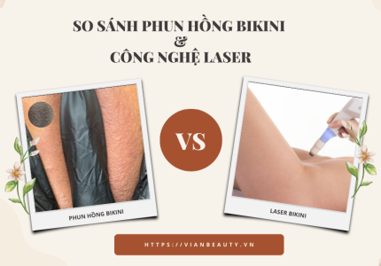 So sánh phun hồng bikini và công nghệ laser
