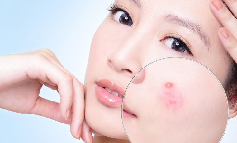 Cách Chăm Sóc Da Mụn