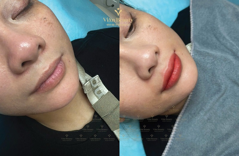 Ket Qua Phun Moi Cho Nu Tai Vian