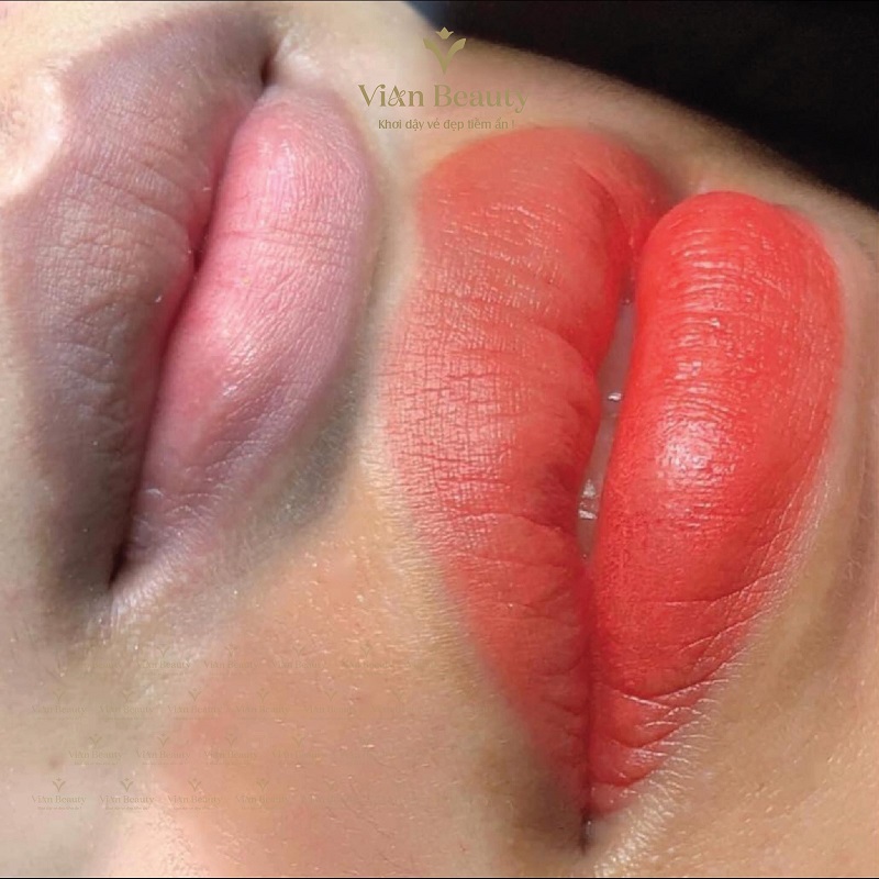 Ket Qua Phun Moi Dep Vian