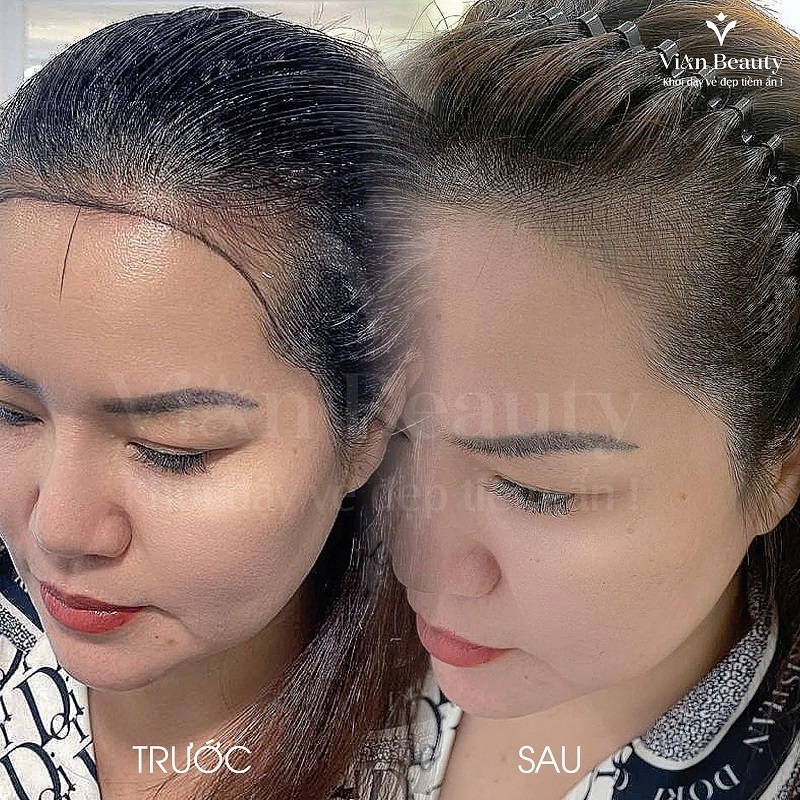 Ket Qua Truoc Sau Dieu Khac Soi Toc 1