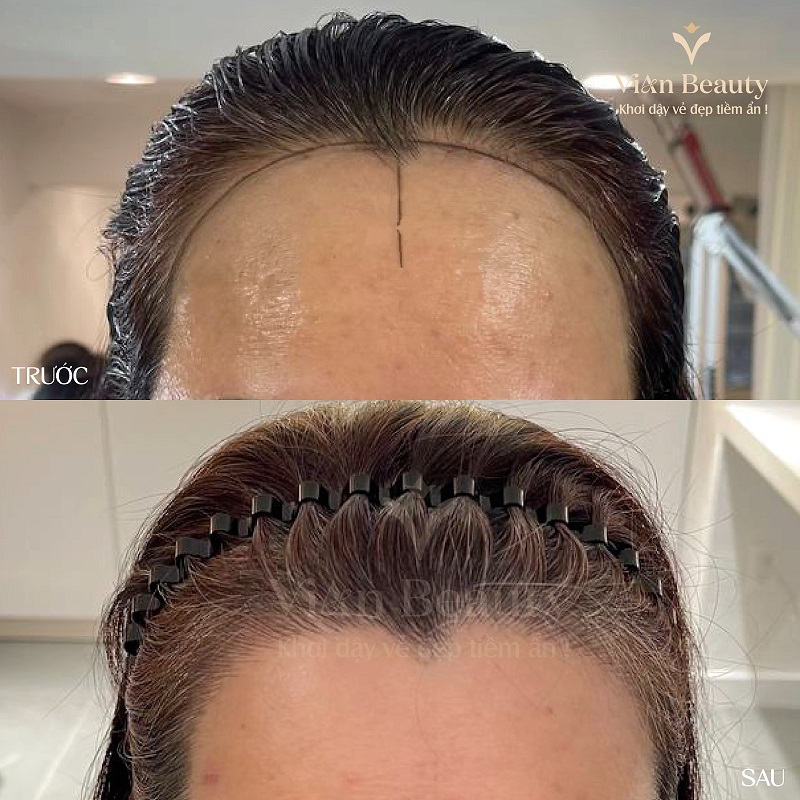 Ket Qua Truoc Sau Dieu Khac Soi Toc 2