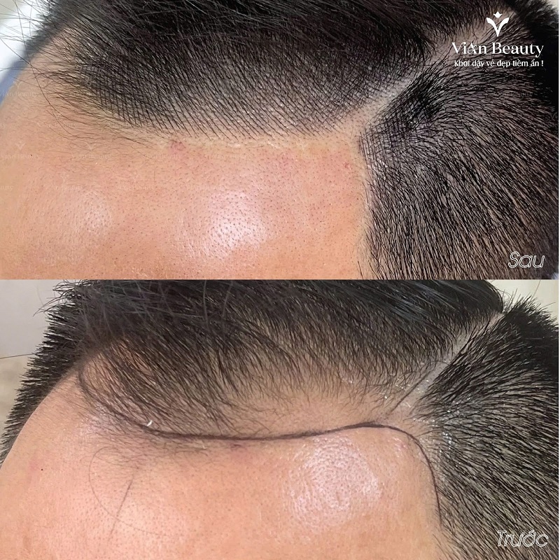 Ket Qua Truoc Sau Dieu Khac Soi Toc 5