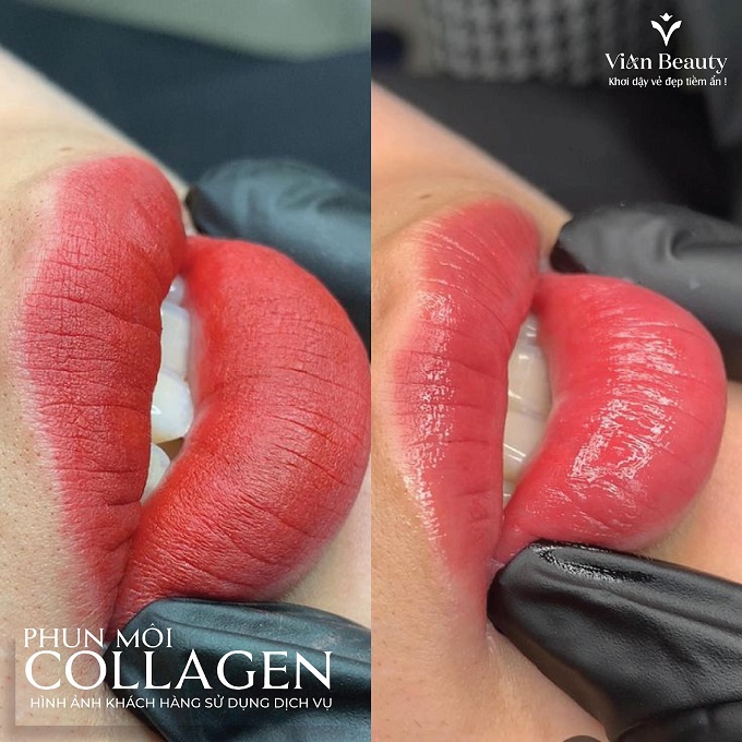 Phun Môi Collagen – Giải Pháp Cho Môi Khô, Thiếu Sức Sống