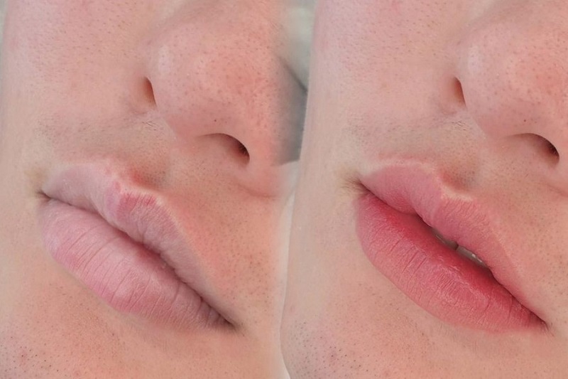 Kết Quả Khử Thâm Môi Nam