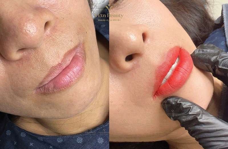 Vian Ket Qua Phun Xam Cho Nu