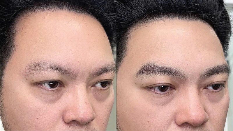 Nam Giới Phù Hợp Với Phương Pháp Làm Đẹp Chân Mày Nào?