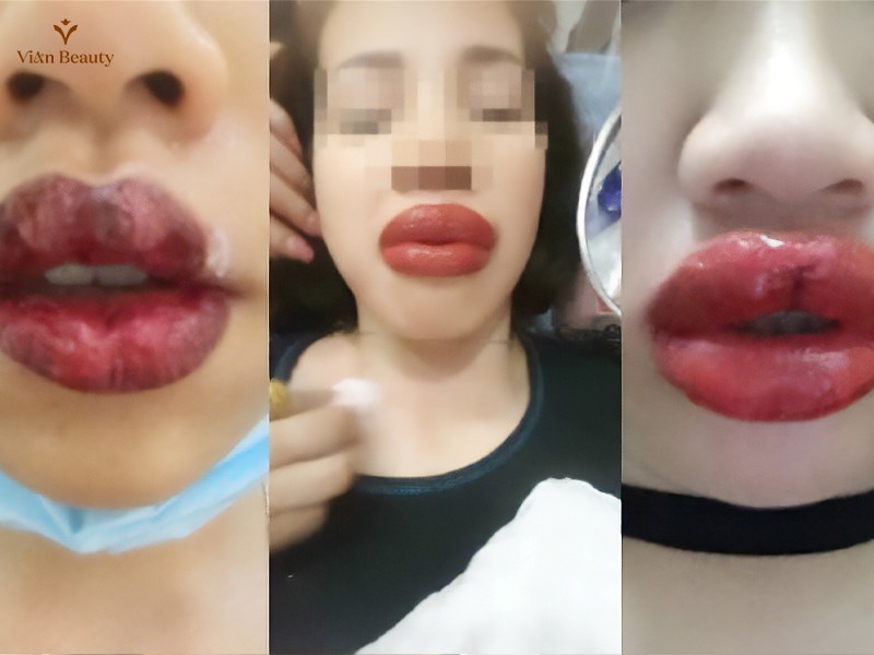 Biến Chứng Phun Xăm Môi Có Thể Gây Ra Những Hậu Quả Nghiêm Trọng