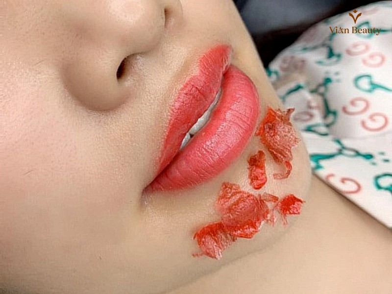 Chăm Sóc Môi Giai Đoạn Bong Vảy