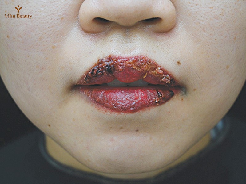 Môi Bị Nứt Nẻ Chảy Máu Sau Khi Phun Xăm