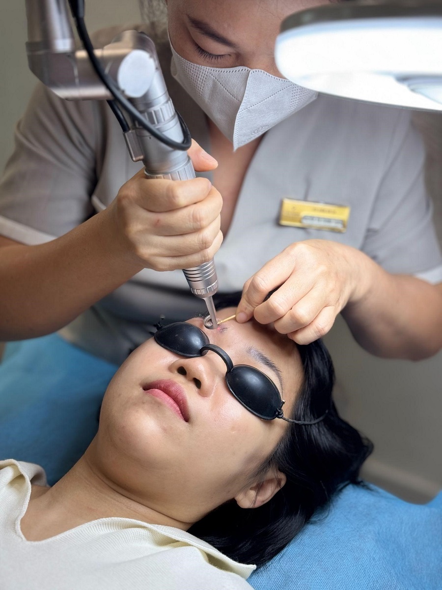 Xóa Xăm Chân Mày Bằng Công Nghệ Laser Tri-Beam