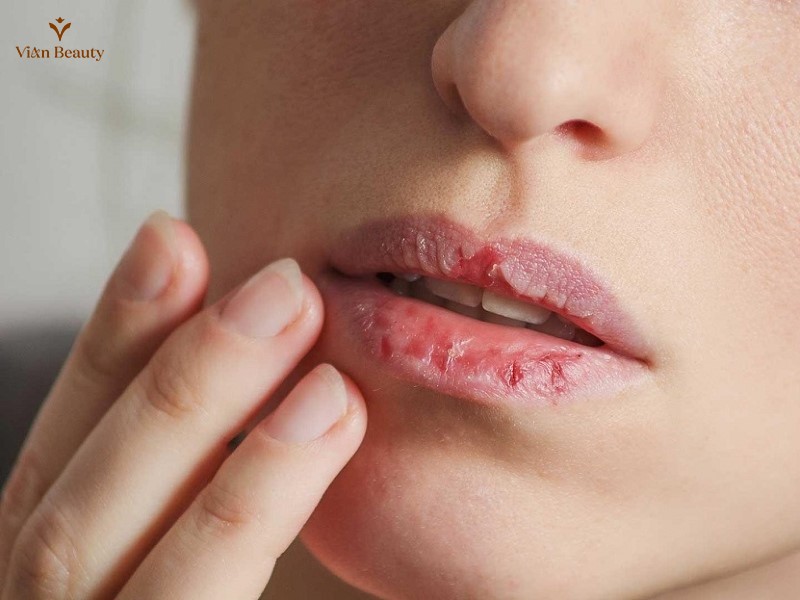 Môi Đau Rát Sau Khi Phun Xăm
