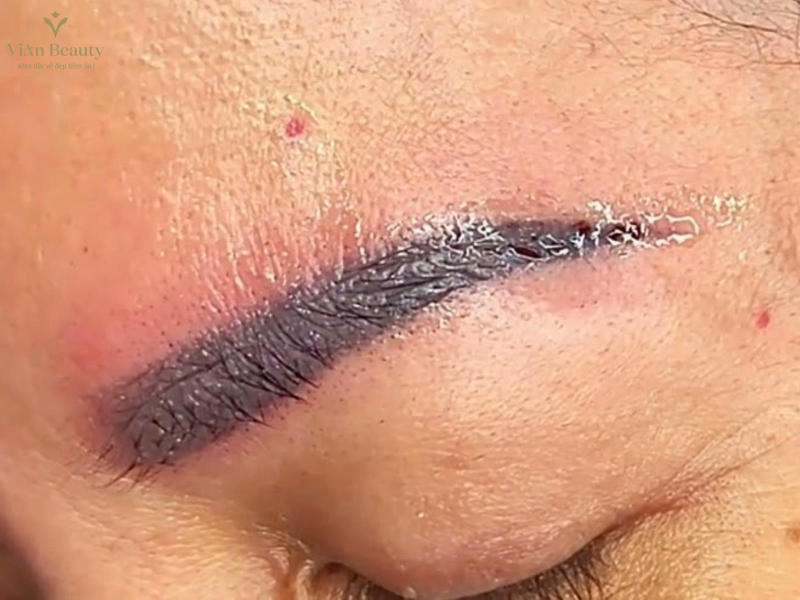 Các Biến Chứng Thường Gặp Khi Phun Xăm Mày