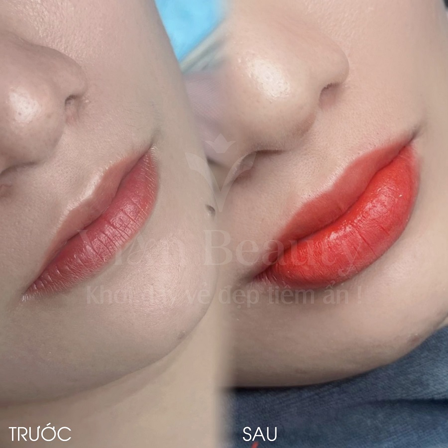 Hình Ảnh Thực Tế Phun Môi Vi Điểm Tại Vian