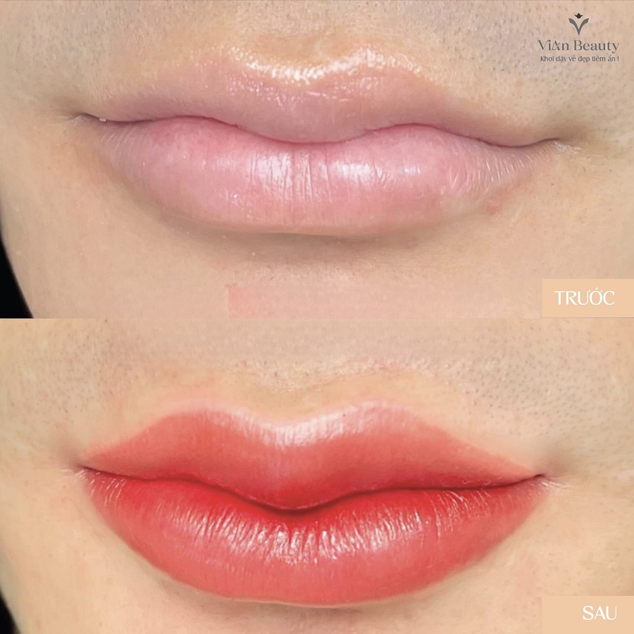 Hình Ảnh Trước Và Sau Khi Phun Môi Collagen Tại Vian