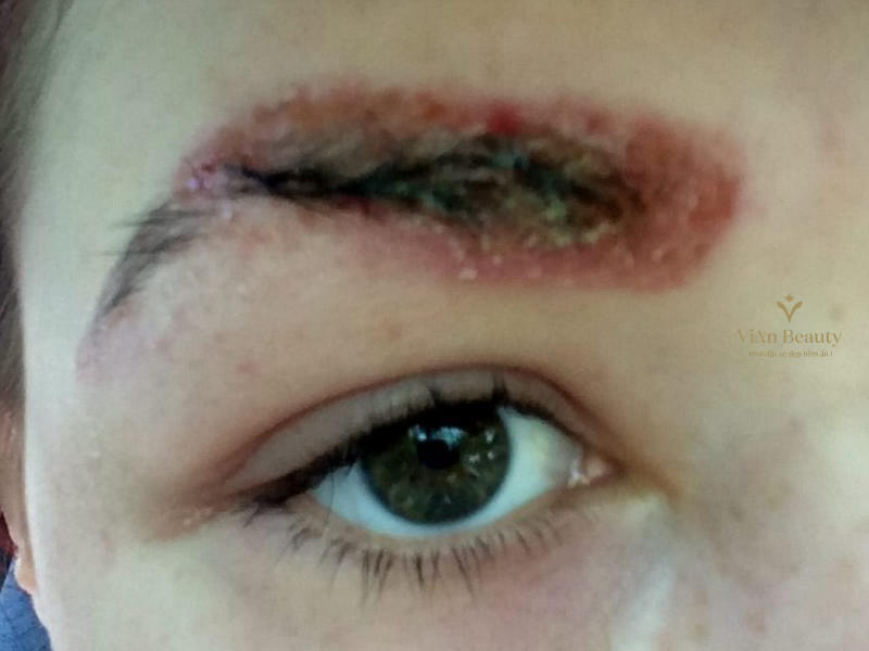 Các Biến Chứng Thường Gặp Khi Phun Xăm Mày