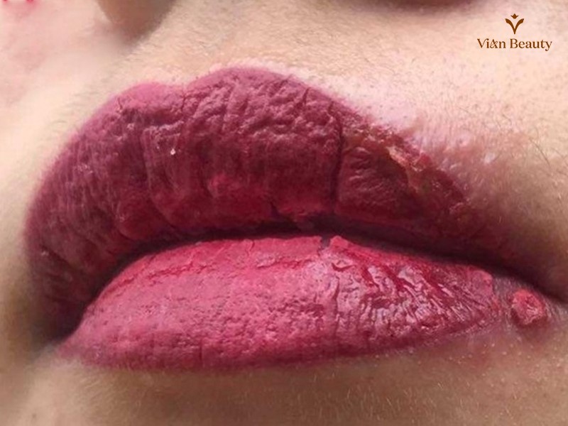 Mụn Nước Sau Phun Môi Thường Do Nhiễm Trùng Hoặc Kích Ứng Da