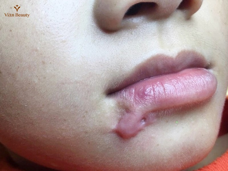 Môi Bị Sẹo Lồi, Sẹo Lõm Sau Phun Xăm