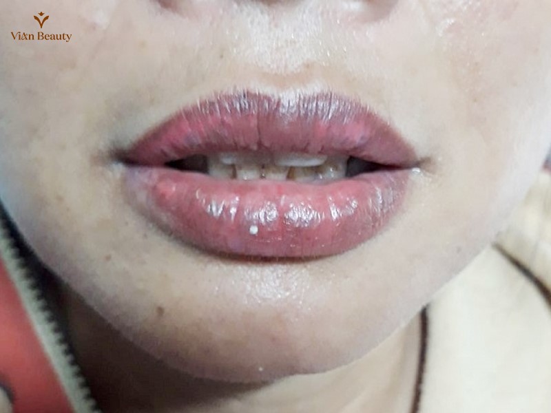 Môi Bị Thâm, Xỉn Màu, Lên Màu Không Đều, Loang Lổ Sau Phun Xăm