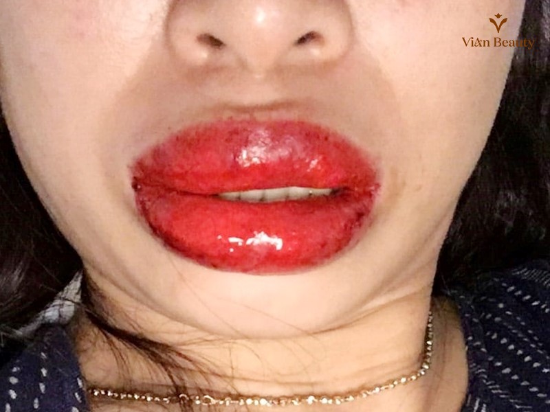 Sưng Tấy Và Khó Chịu Là Hiện Tượng Phổ Biến Sau Khi Phun Môi