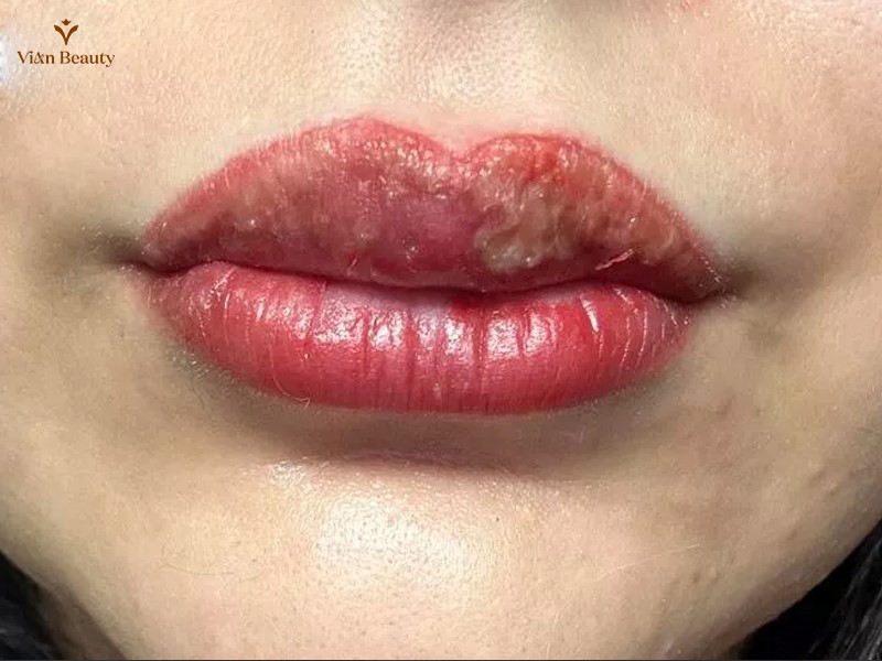 Môi Nổi Mụn Nước, Rộp Sau Phun Xăm