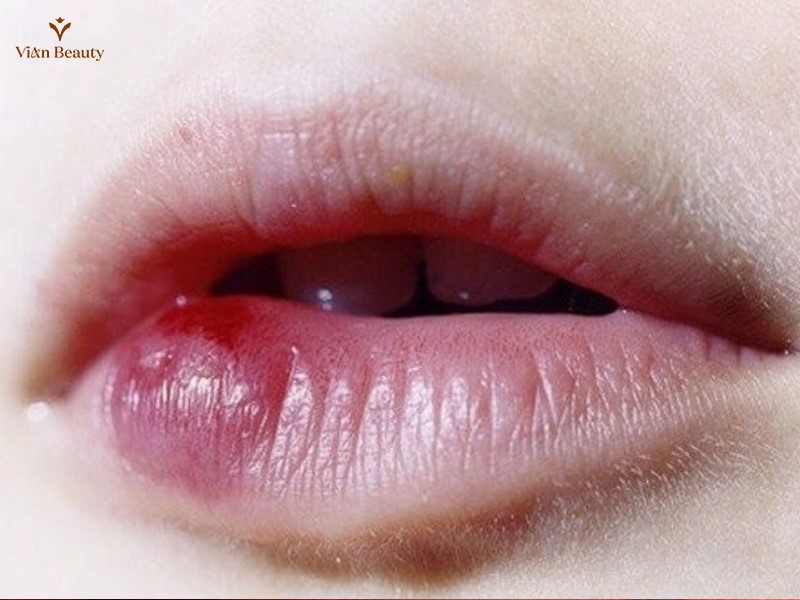 Môi Phản Ứng Dị Ứng Với Mực Xăm