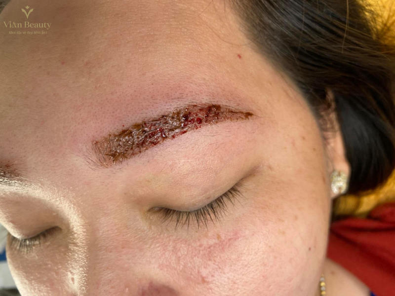 Các Biến Chứng Thường Gặp Khi Phun Xăm Mày