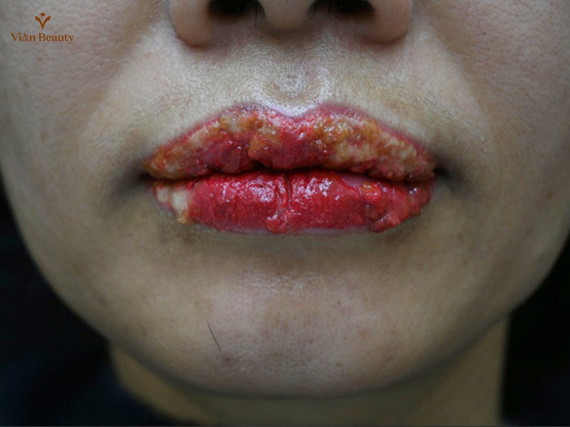 Môi Bị Nhiễm Trùng Sau Khi Phun Xăm