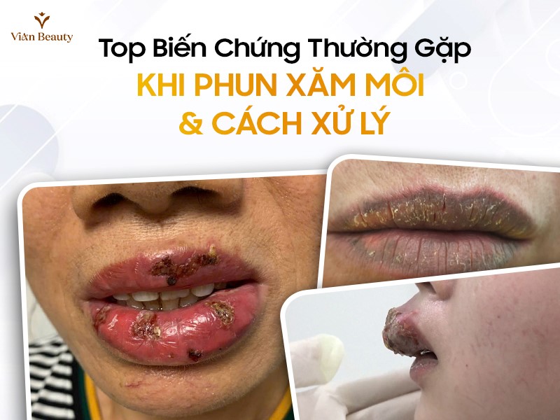 Những Biến Chứng Thường Gặp Khi Phun Xăm Môi