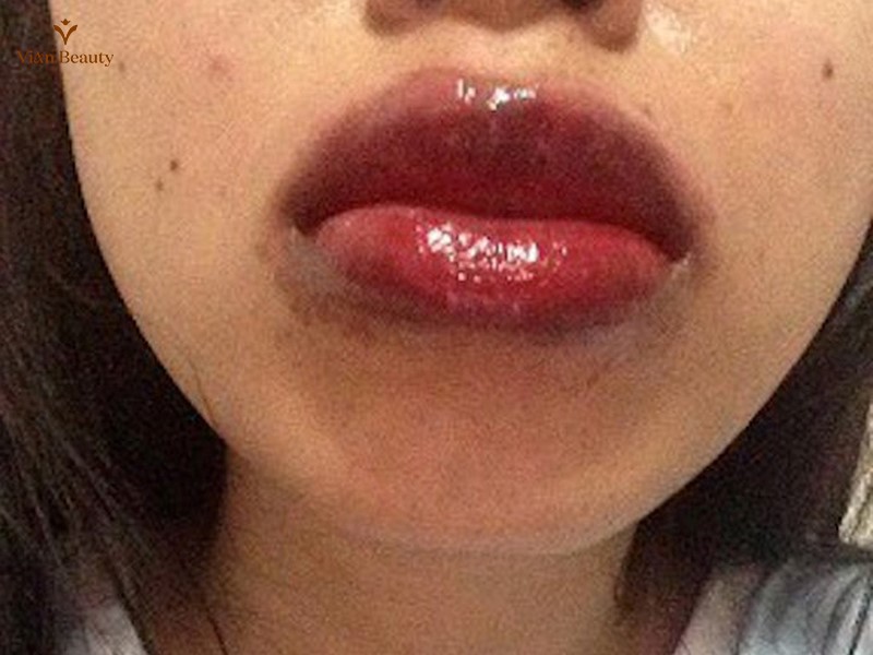 Sưng, Bầm Tím Là Phản Ứng Thông Thường Sau Khi Phun Xăm Môi