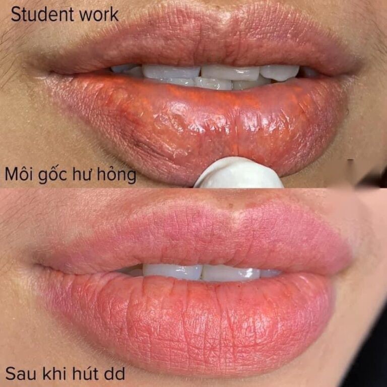 Hút Mực Môi Sau Phun Xăm Giúp Trả Lại Màu Sắc Môi Đẹp