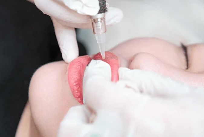 Phương Pháp Hút Mực Môi Bằng Laser Được Khuyên Dùng