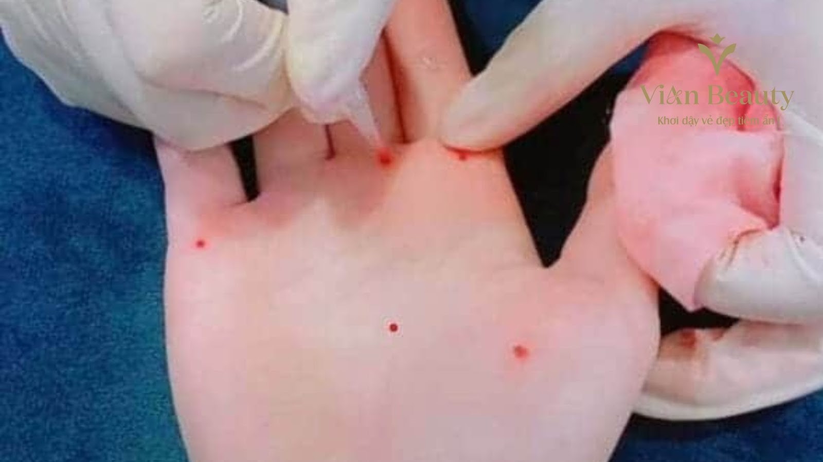 Chấm Nốt Ruồi Phong Thủy