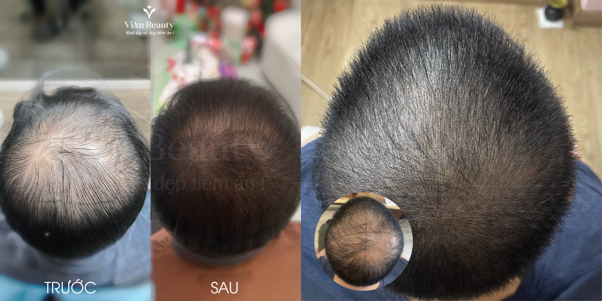 Điêu Khắc Sợi Tóc Đỉnh Đầu