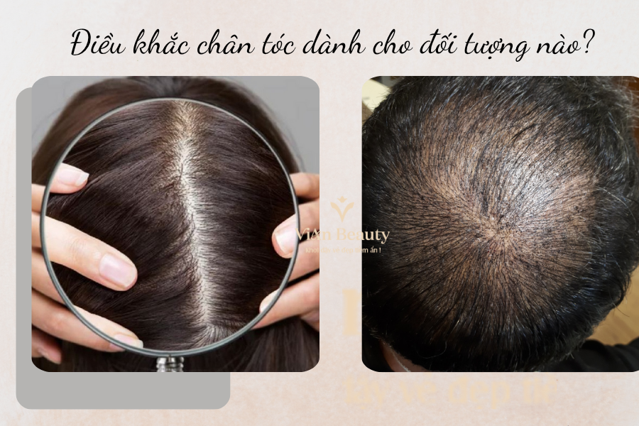 Giải Pháp Cho Hói Đầu