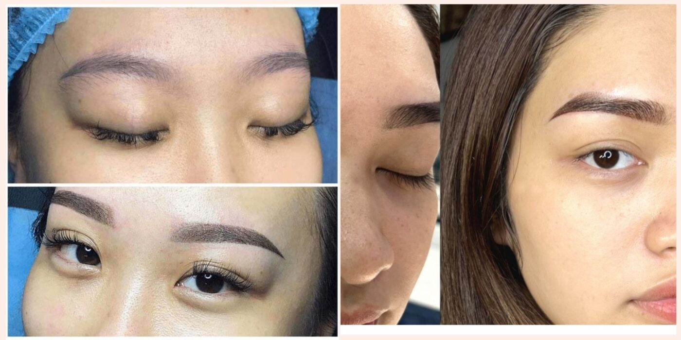 Kết Quả Trước Và Sau Khi Xóa Sửa Chân Mày Lỗi Bằng Laser Tại Vian Beauty