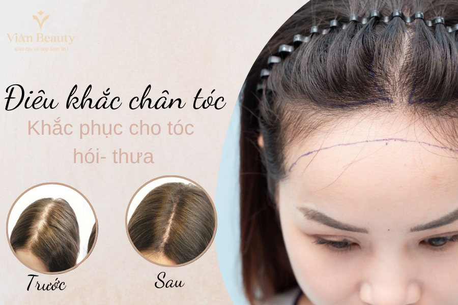 Điêu Khắc Chân Tóc - Giải Pháp Cho Hói Đầu