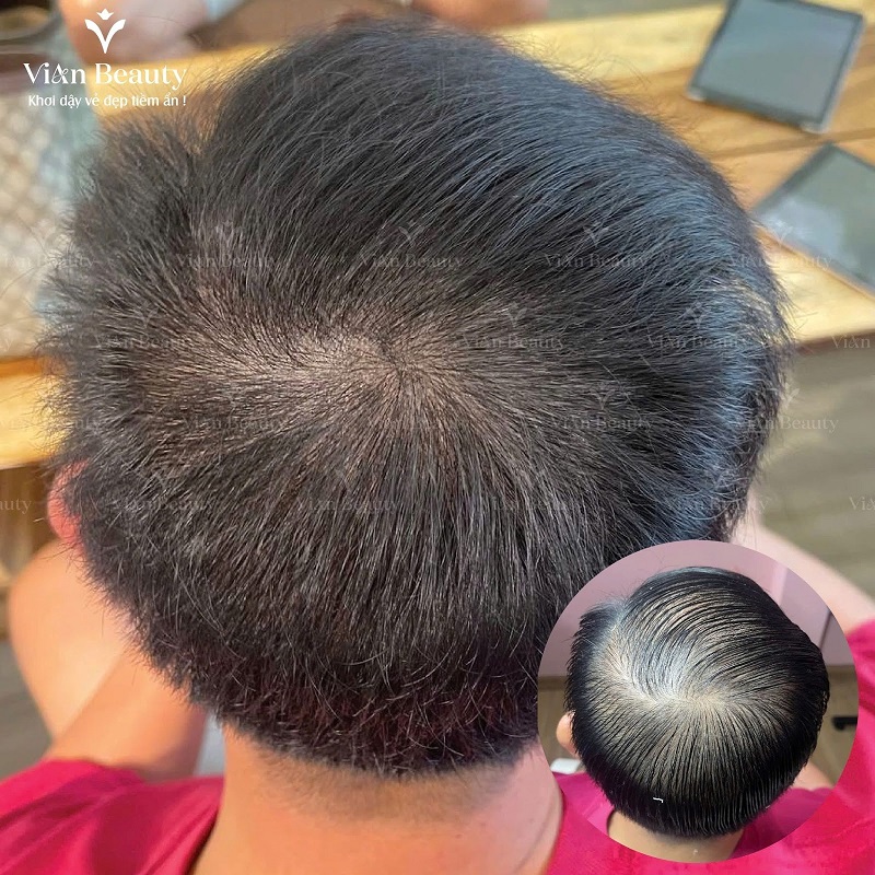 Dieu Khac Soi Toc Vung Truoc Tran 1