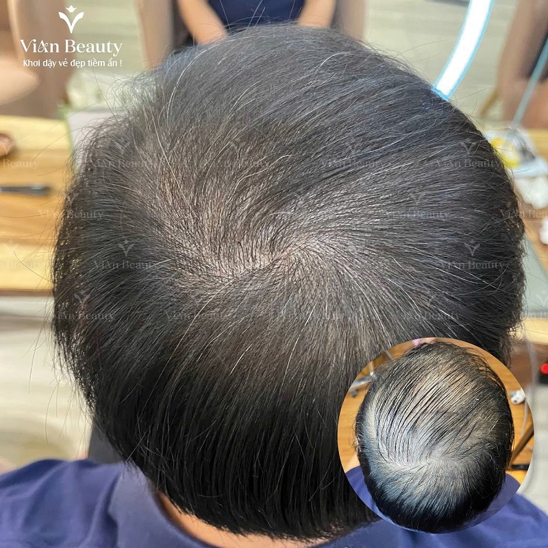 Dieu Khac Soi Toc Vung Truoc Tran 2