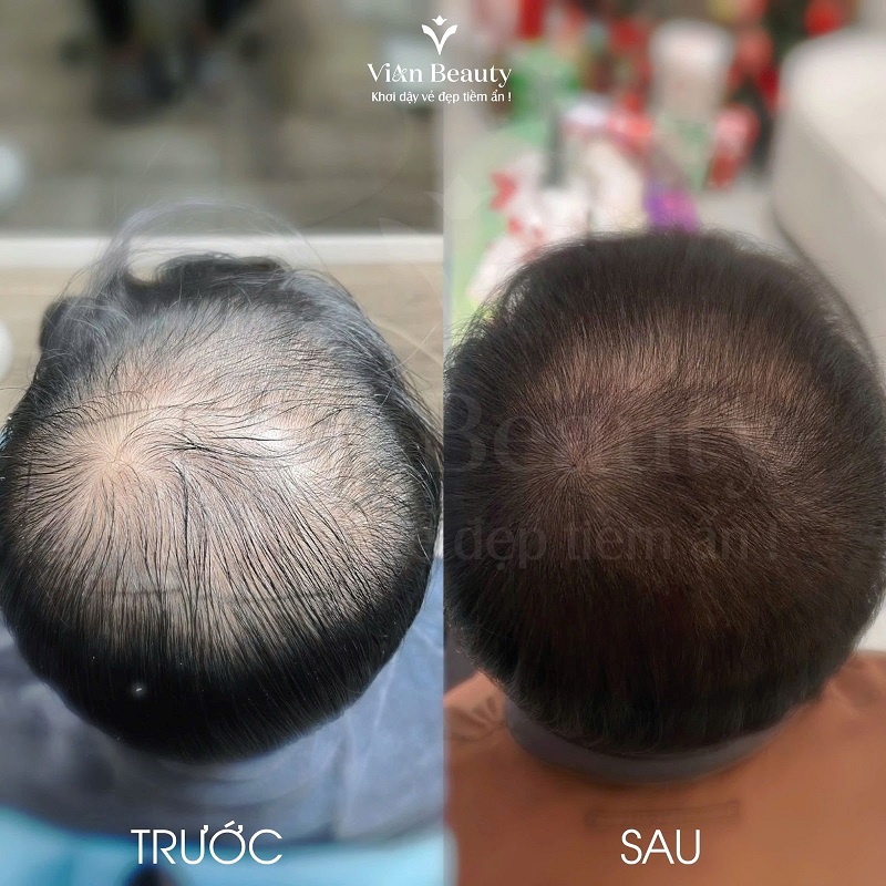 Điêu Khắc Sợi Tóc Vùng Trước Trán