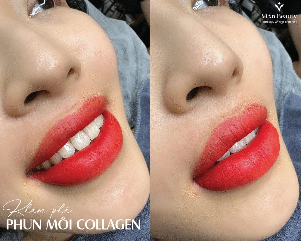Phun Moi Collagen Len Mau Chuan Tai Vian Beauty Hcm 4 1
