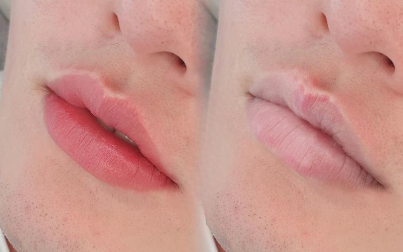 Phun Moi Collagen Len Mau Chuan Tai Vian Beauty Hcm 5