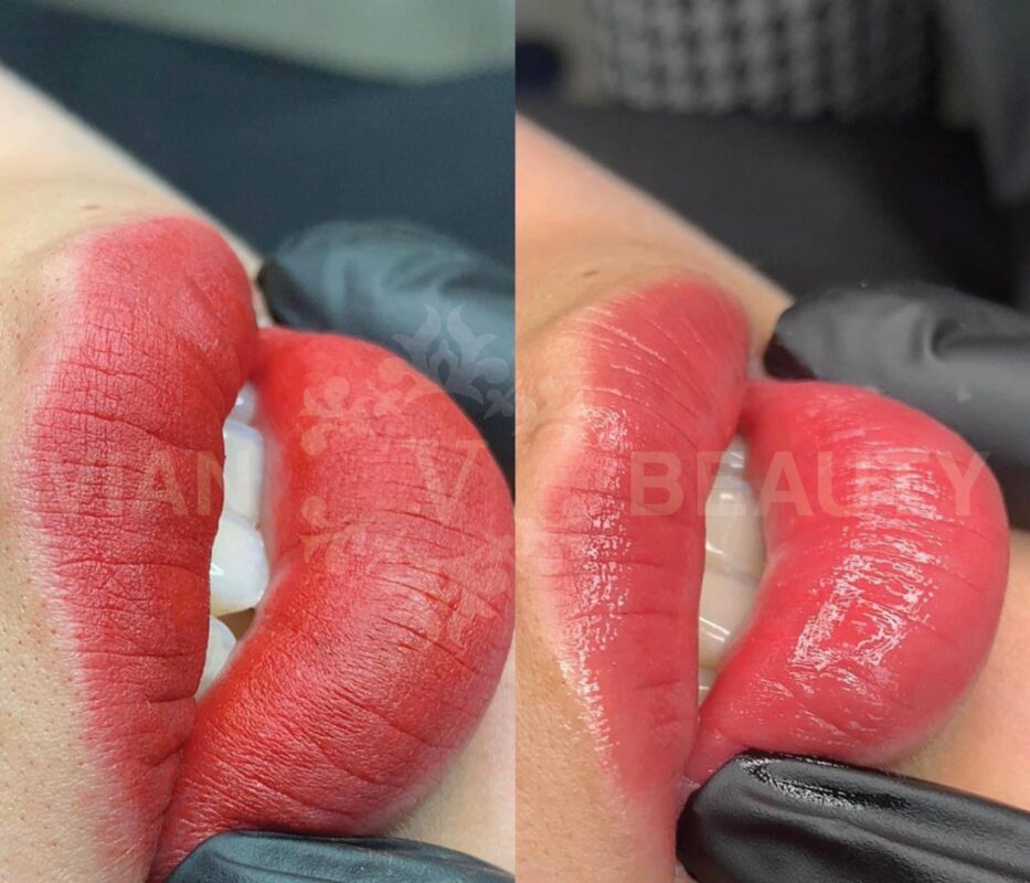 Phun Moi Collagen Len Mau Chuan Tai Vian Beauty Hcm